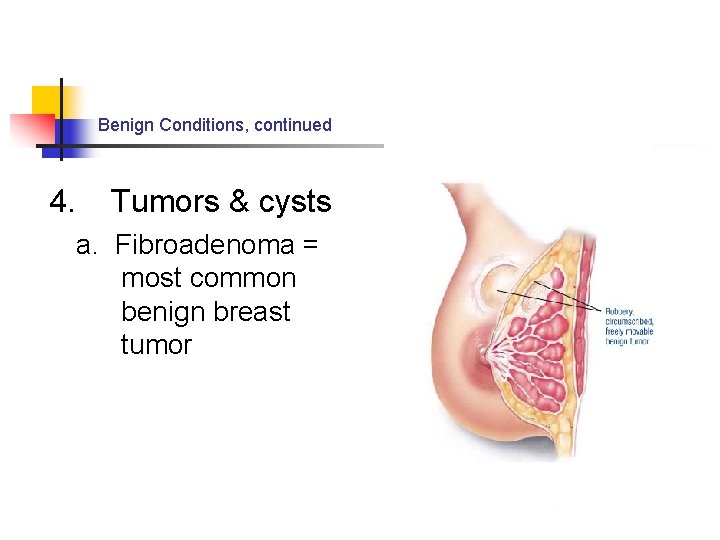 Benign Conditions, continued 4. Tumors & cysts a. Fibroadenoma = most common benign breast