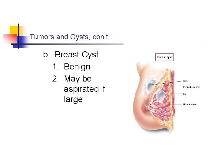 Tumors and Cysts, con’t… b. Breast Cyst 1. Benign 2. May be aspirated if