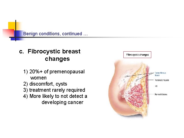 Benign conditions, continued … c. Fibrocystic breast changes 1) 20%+ of premenopausal women 2)