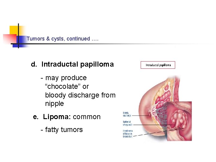 Tumors & cysts, continued …. d. Intraductal papilloma - may produce “chocolate” or bloody