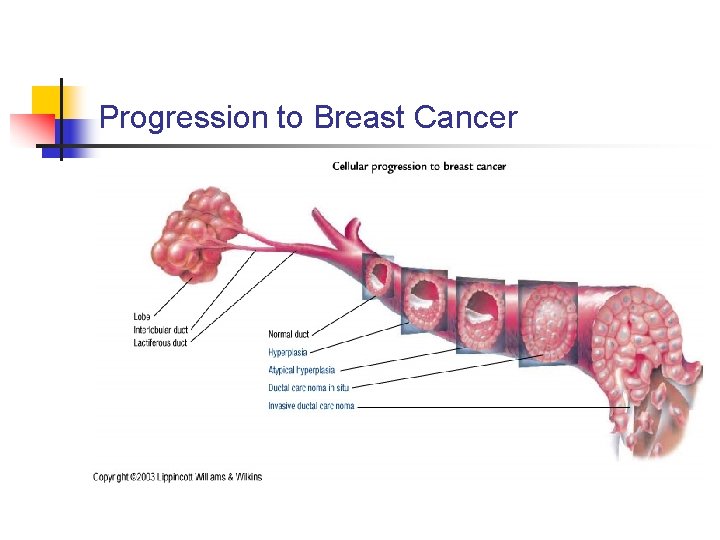 Progression to Breast Cancer 