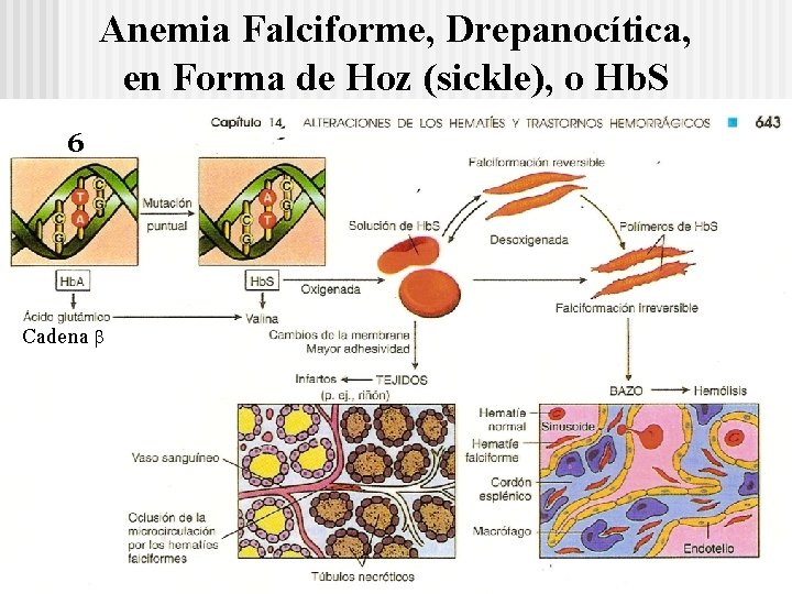 Anemia Falciforme, Drepanocítica, en Forma de Hoz (sickle), o Hb. S 6 Cadena 