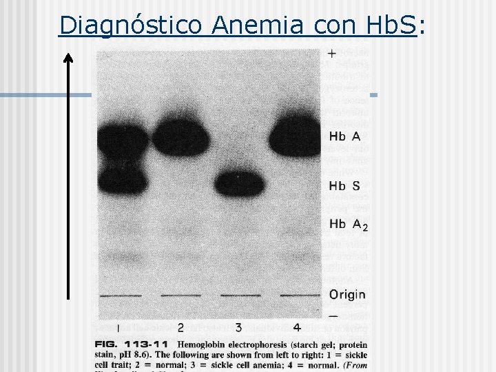 Diagnóstico Anemia con Hb. S: 