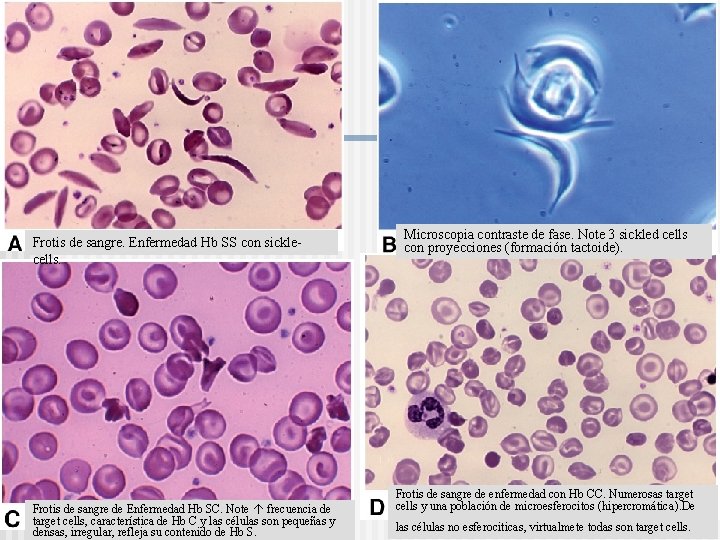 Frotis de sangre. Enfermedad Hb SS con sicklecells. Frotis de sangre de Enfermedad Hb