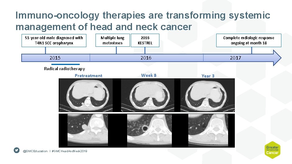 Immuno-oncology therapies are transforming systemic management of head and neck cancer 51 -year-old male