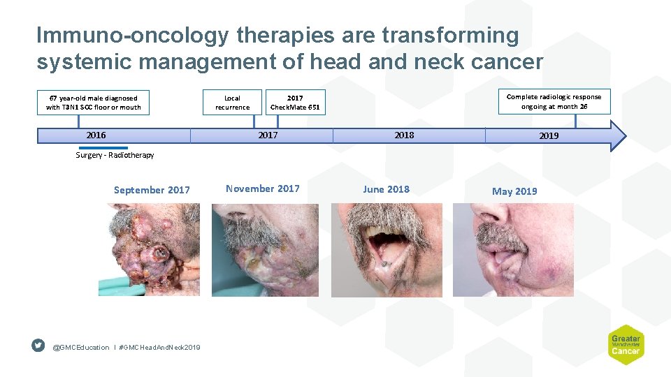 Immuno-oncology therapies are transforming systemic management of head and neck cancer 67 year-old male