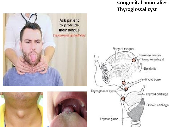 Congenital anomalies Thyroglossal cyst 