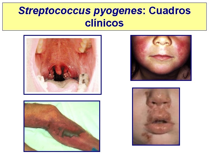 Streptococcus pyogenes: Cuadros clínicos 