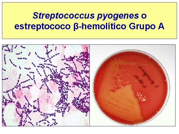 Streptococcus pyogenes o estreptococo β-hemolítico Grupo A 