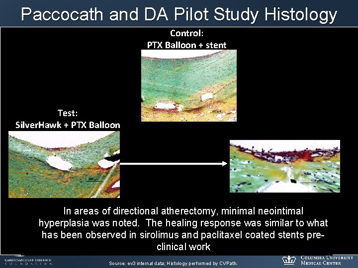 Paccocath and DA Pilot Study Histology Control: PTX Balloon + stent Test: Silver. Hawk