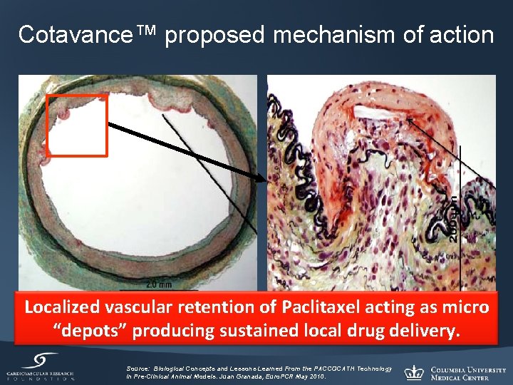Cotavance™ proposed mechanism of action Localized vascular retention of Paclitaxel acting as micro “depots”