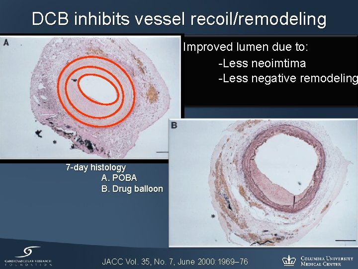 DCB inhibits vessel recoil/remodeling Improved lumen due to: -Less neoimtima -Less negative remodeling 7