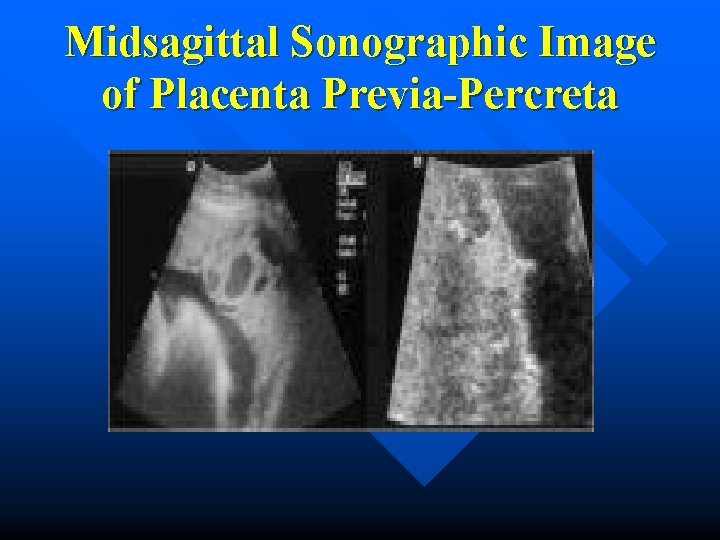 Midsagittal Sonographic Image of Placenta Previa-Percreta 