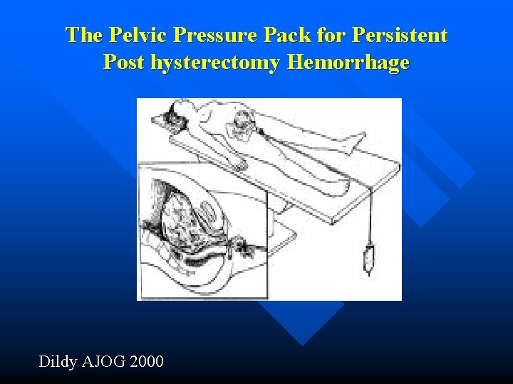 The Pelvic Pressure Pack for Persistent Post hysterectomy Hemorrhage Dildy AJOG 2000 