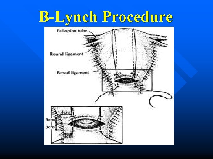 B-Lynch Procedure 