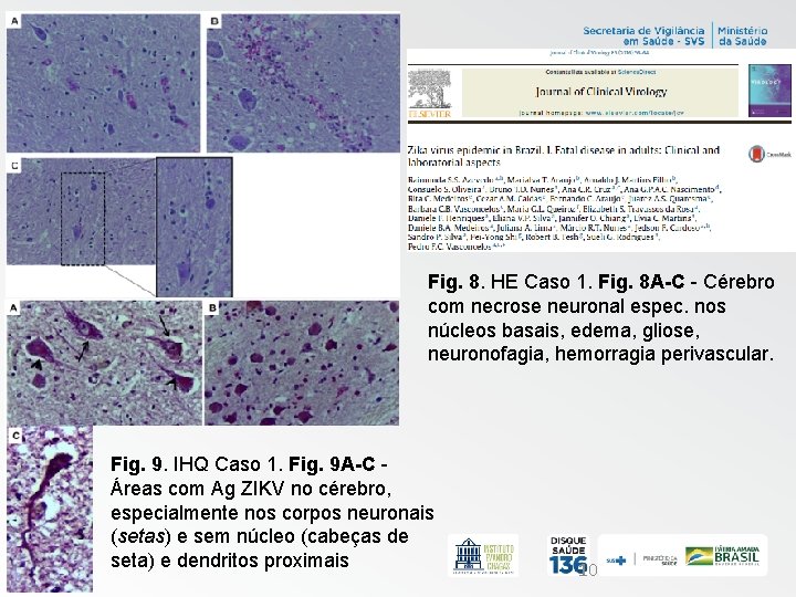 Fig. 8. HE Caso 1. Fig. 8 A-C - Cérebro com necrose neuronal espec.