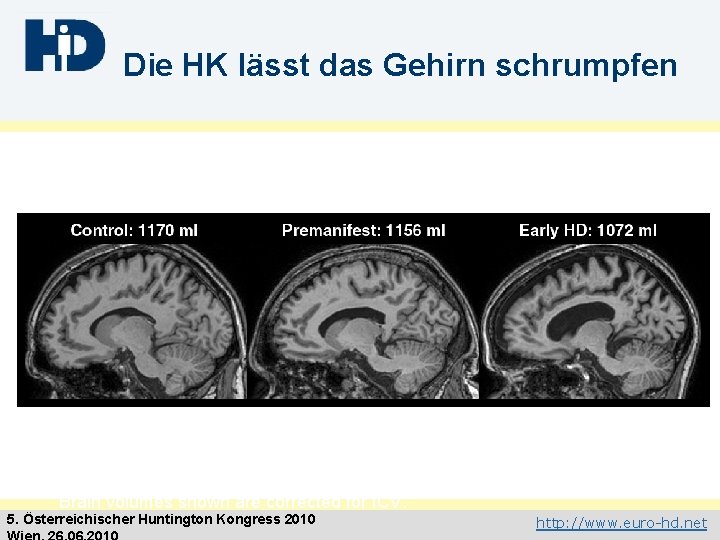 Die HK lässt das Gehirn schrumpfen Brain volumes shown are corrected for ICV. 5.