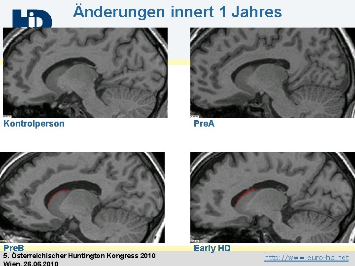 Änderungen innert 1 Jahres Kontrolperson Pre. A Pre. B Early HD 5. Österreichischer Huntington