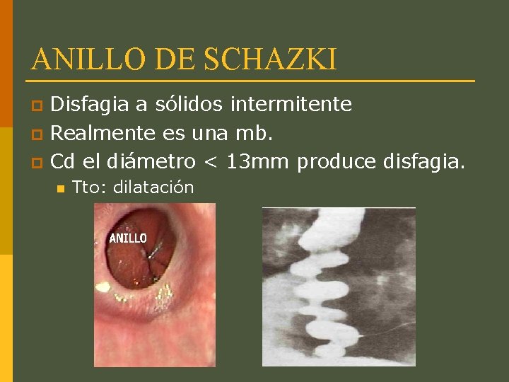 ANILLO DE SCHAZKI Disfagia a sólidos intermitente p Realmente es una mb. p Cd