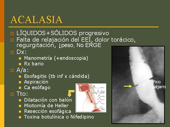 ACALASIA p p p LÍQUIDOS+SÓLIDOS progresivo Falta de relajación del EEI, dolor torácico, regurgitación,