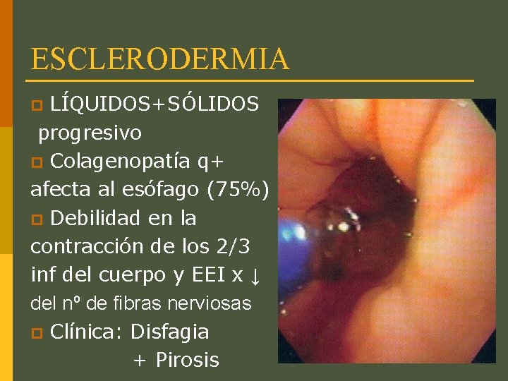 ESCLERODERMIA LÍQUIDOS+SÓLIDOS progresivo p Colagenopatía q+ afecta al esófago (75%) p Debilidad en la