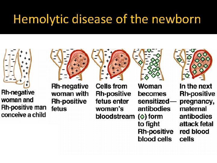 Hemolytic disease of the newborn 