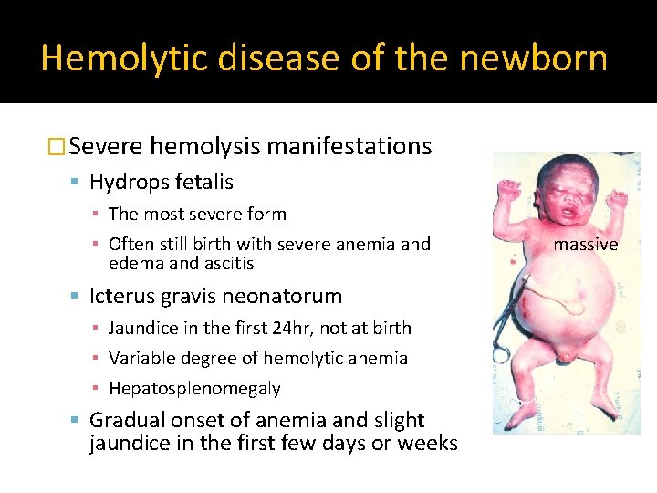 Hemolytic disease of the newborn �Severe hemolysis manifestations Hydrops fetalis ▪ The most severe
