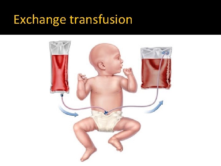 Exchange transfusion 