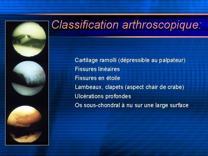 Classification arthroscopique: Cartilage ramolli (dépressible au palpateur) Fissures linéaires Fissures en étoile Lambeaux, clapets