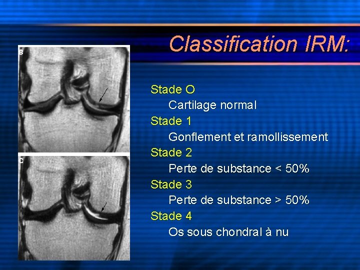 Classification IRM: Stade O Cartilage normal Stade 1 Gonflement et ramollissement Stade 2 Perte