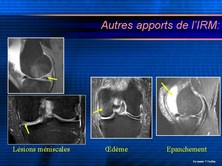 Autres apports de l’IRM: Lésions méniscales Œdème Epanchement Documents Y Carillon 