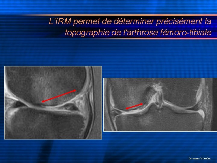 L’IRM permet de déterminer précisément la topographie de l'arthrose fémoro-tibiale Documents Y Carillon 