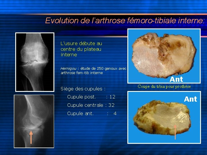 Evolution de l’arthrose fémoro-tibiale interne: L’usure débute au centre du plateau interne Hernigou :