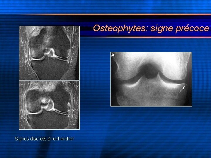 Osteophytes: signe précoce Signes discrets à recher 