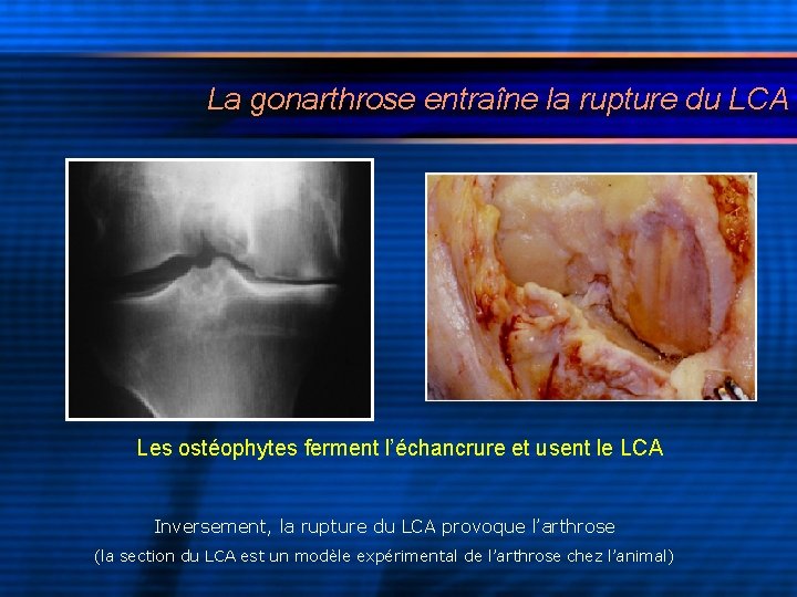 La gonarthrose entraîne la rupture du LCA Les ostéophytes ferment l’échancrure et usent le