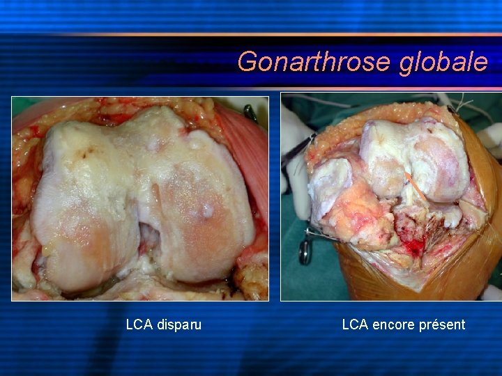 Gonarthrose globale LCA disparu LCA encore présent 