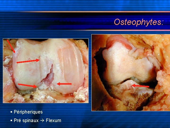 Osteophytes: § Péripheriques § Pré spinaux Flexum 