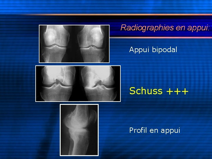 Radiographies en appui: Appui bipodal Schuss +++ Profil en appui 
