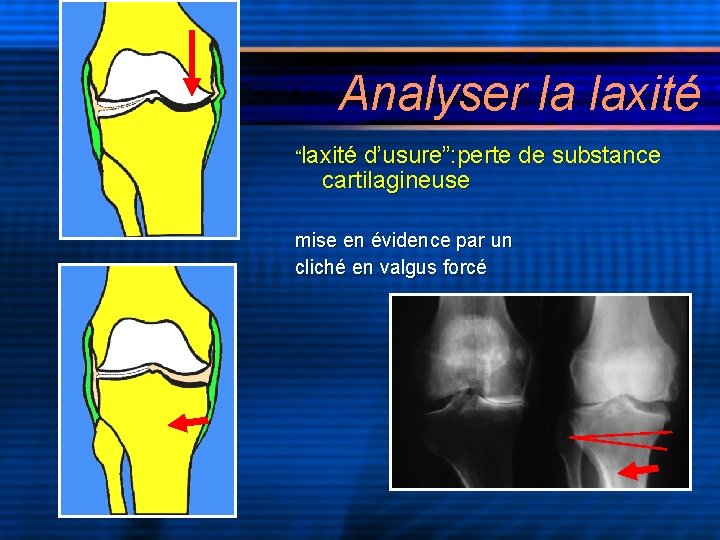 Analyser la laxité “laxité d’usure”: perte de substance cartilagineuse mise en évidence par un