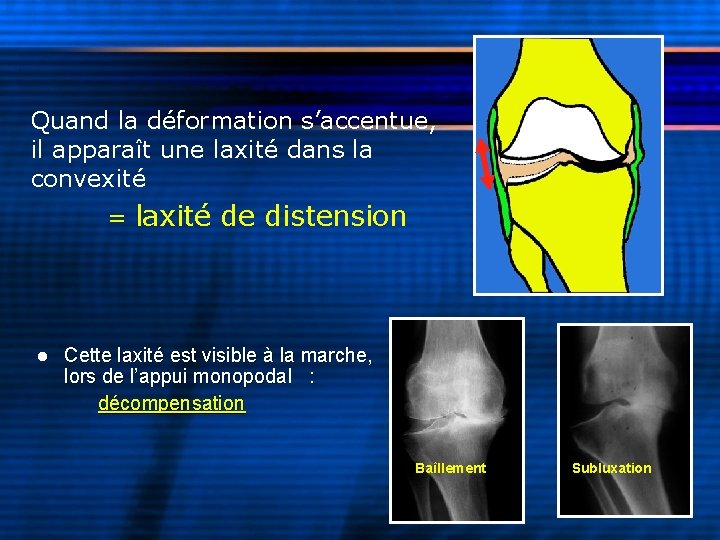 Quand la déformation s’accentue, il apparaît une laxité dans la convexité = laxité de