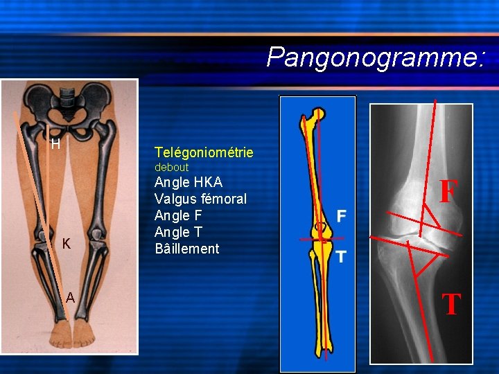 Pangonogramme: H Telégoniométrie debout K A Angle HKA Valgus fémoral Angle F Angle T