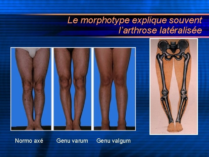 Le morphotype explique souvent l’arthrose latéralisée Normo axé Genu varum Genu valgum 