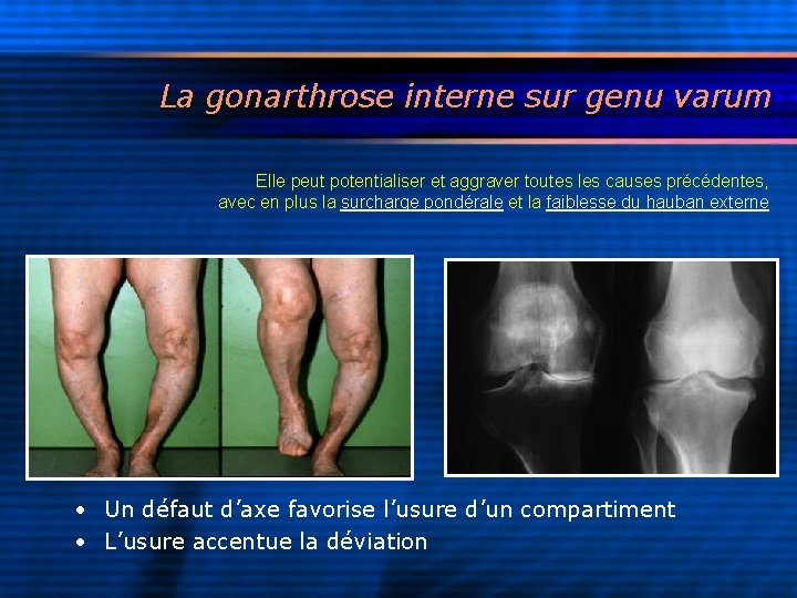 La gonarthrose interne sur genu varum Elle peut potentialiser et aggraver toutes les causes