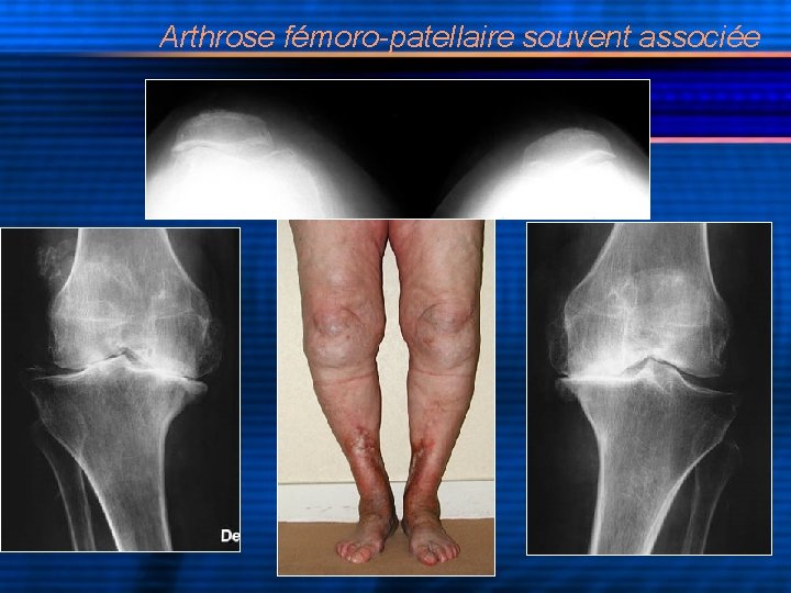 Arthrose fémoro-patellaire souvent associée 