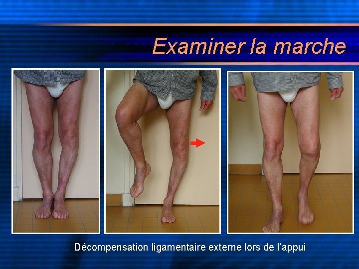 Examiner la marche Décompensation ligamentaire externe lors de l’appui 