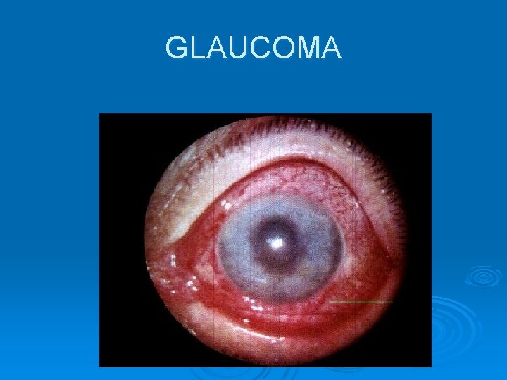 GLAUCOMA 