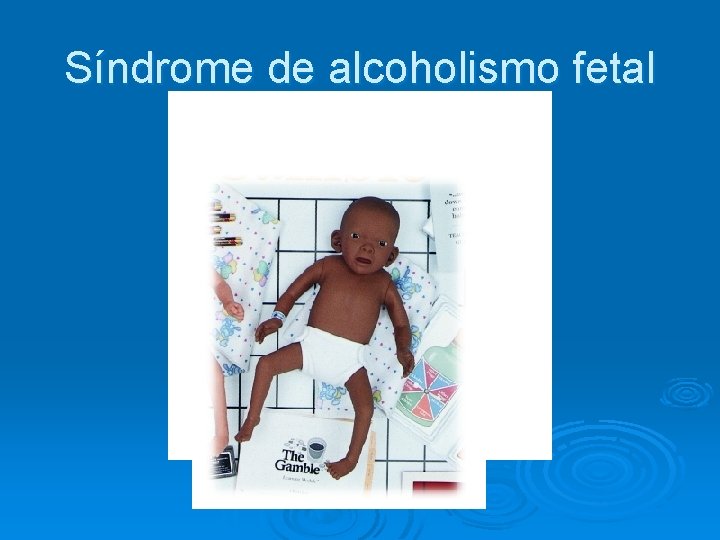 Síndrome de alcoholismo fetal 