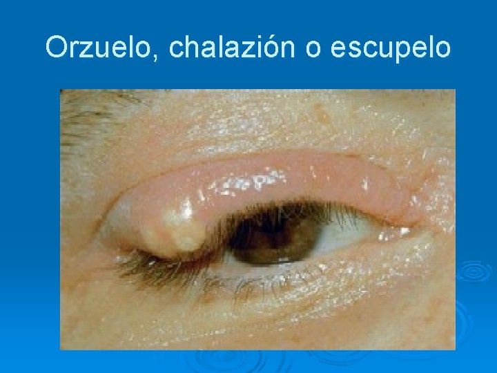 Orzuelo, chalazión o escupelo 