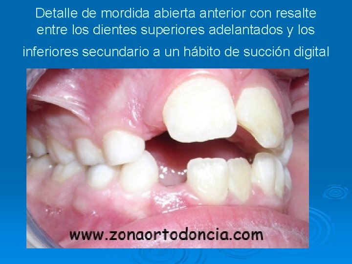 Detalle de mordida abierta anterior con resalte entre los dientes superiores adelantados y los