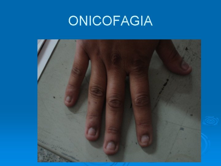 ONICOFAGIA 